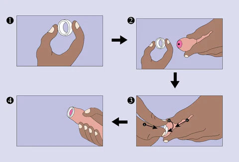 How to Use Phimosis Rings for Treating Phimosis at Home- by Phimostretch